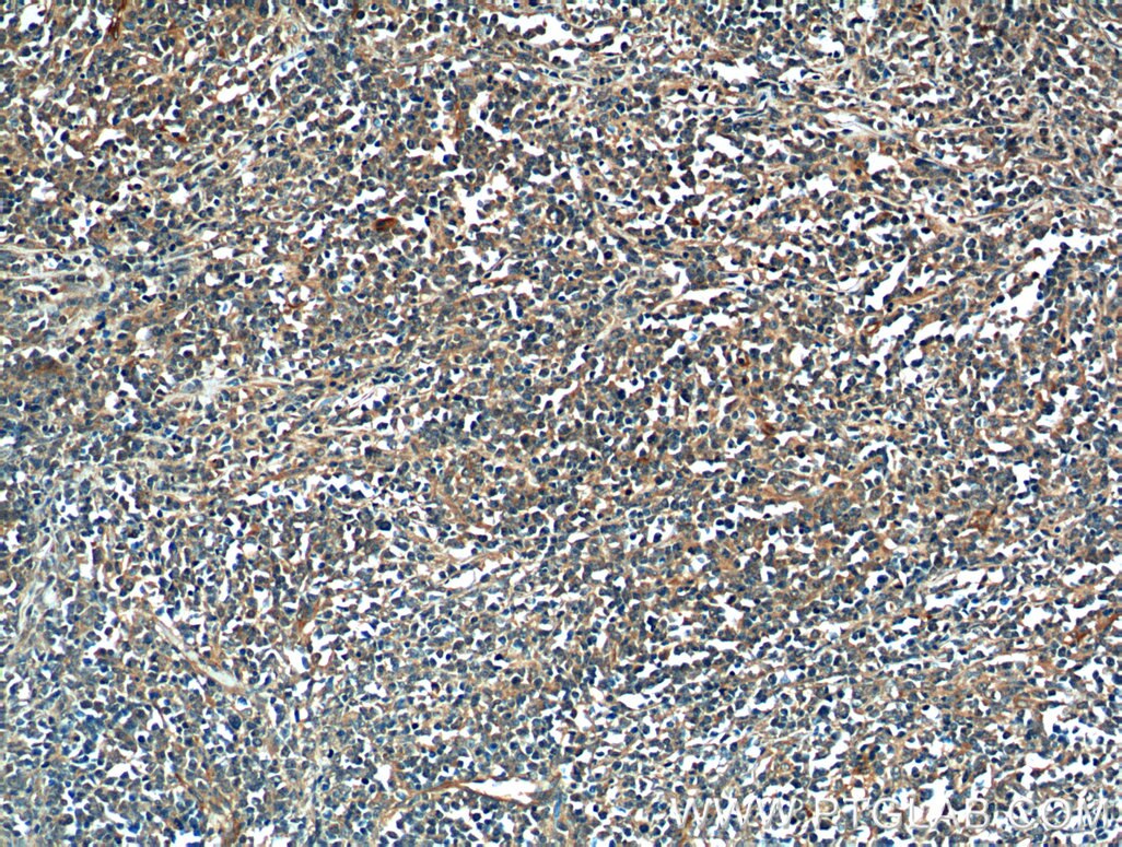 Immunohistochemistry (IHC) staining of human lymphoma tissue using CAB39L Polyclonal antibody (16137-1-AP)