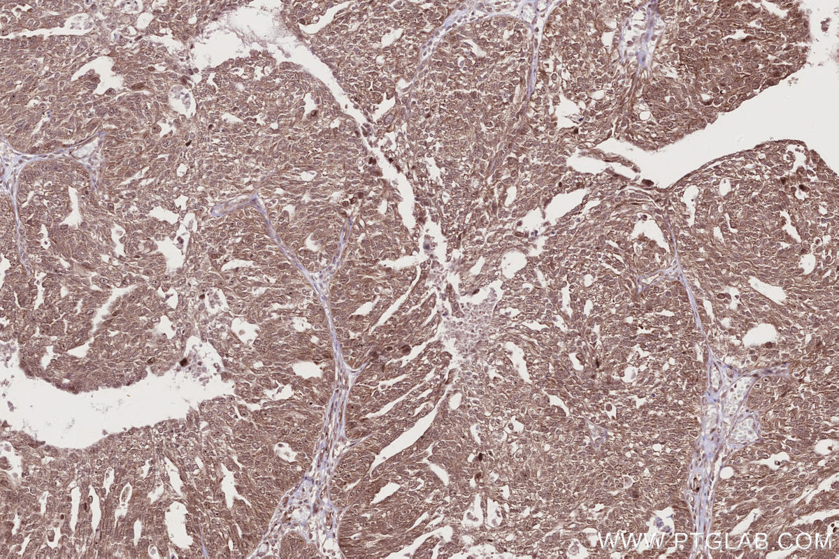 IHC staining of human ovary cancer using 13464-1-AP Immunohistochemistry (IHC) staining of human ovary cancer tissue using CABLES1 Polyclonal antibody (13464-1-AP)