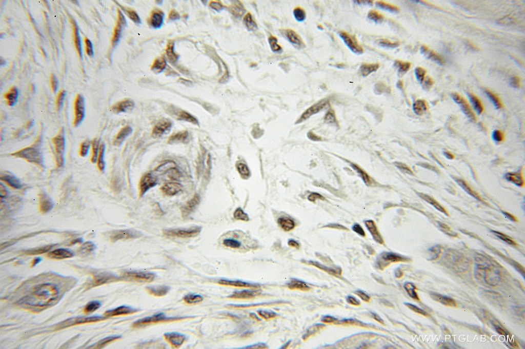Immunohistochemistry (IHC) staining of human pancreas cancer tissue using CABYR Polyclonal antibody (12351-1-AP)