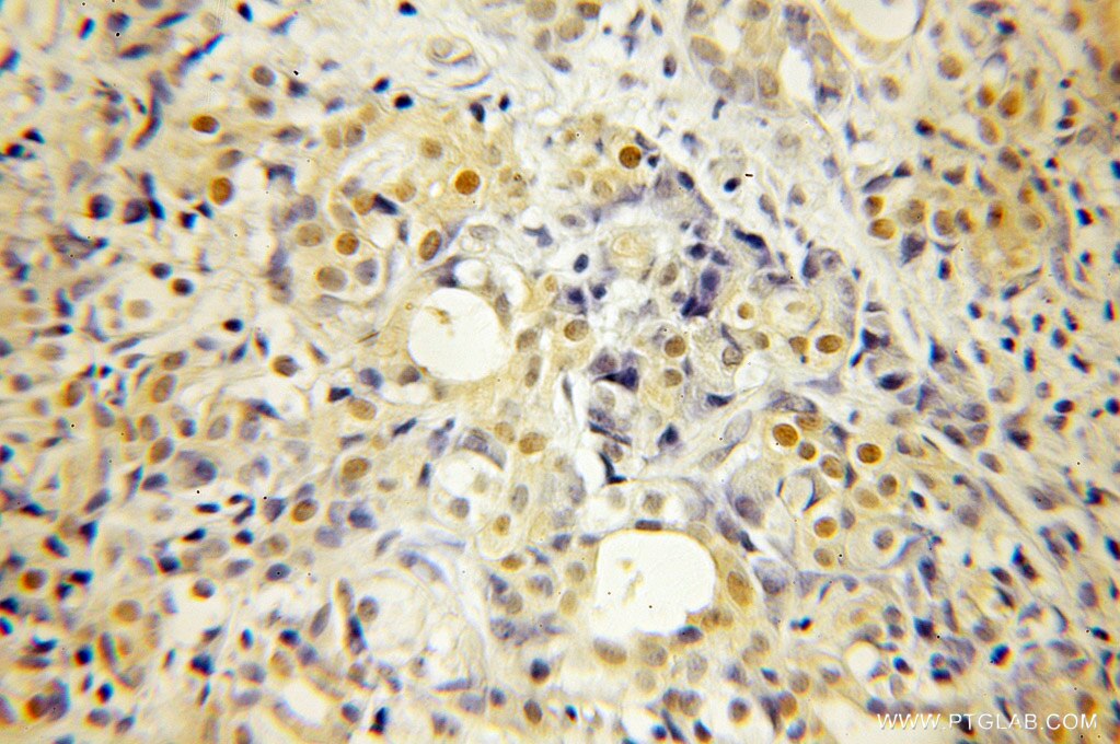 Immunohistochemistry (IHC) staining of human pancreas cancer tissue using CABYR Polyclonal antibody (12351-1-AP)