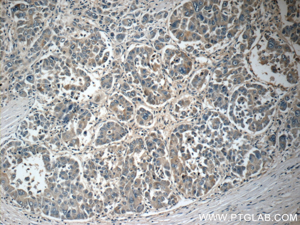 IHC staining of human liver cancer using 18389-1-AP