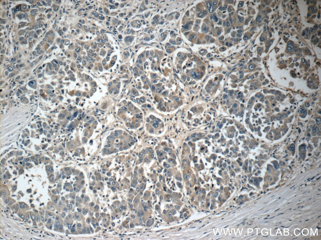 Immunohistochemistry (IHC) staining of human liver cancer tissue using CACNG1 Polyclonal antibody (18389-1-AP)