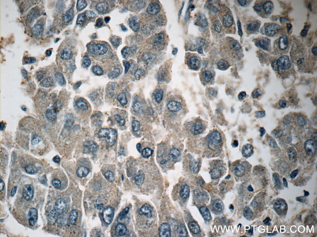 Immunohistochemistry (IHC) staining of human liver cancer tissue using CACNG1 Polyclonal antibody (18389-1-AP)