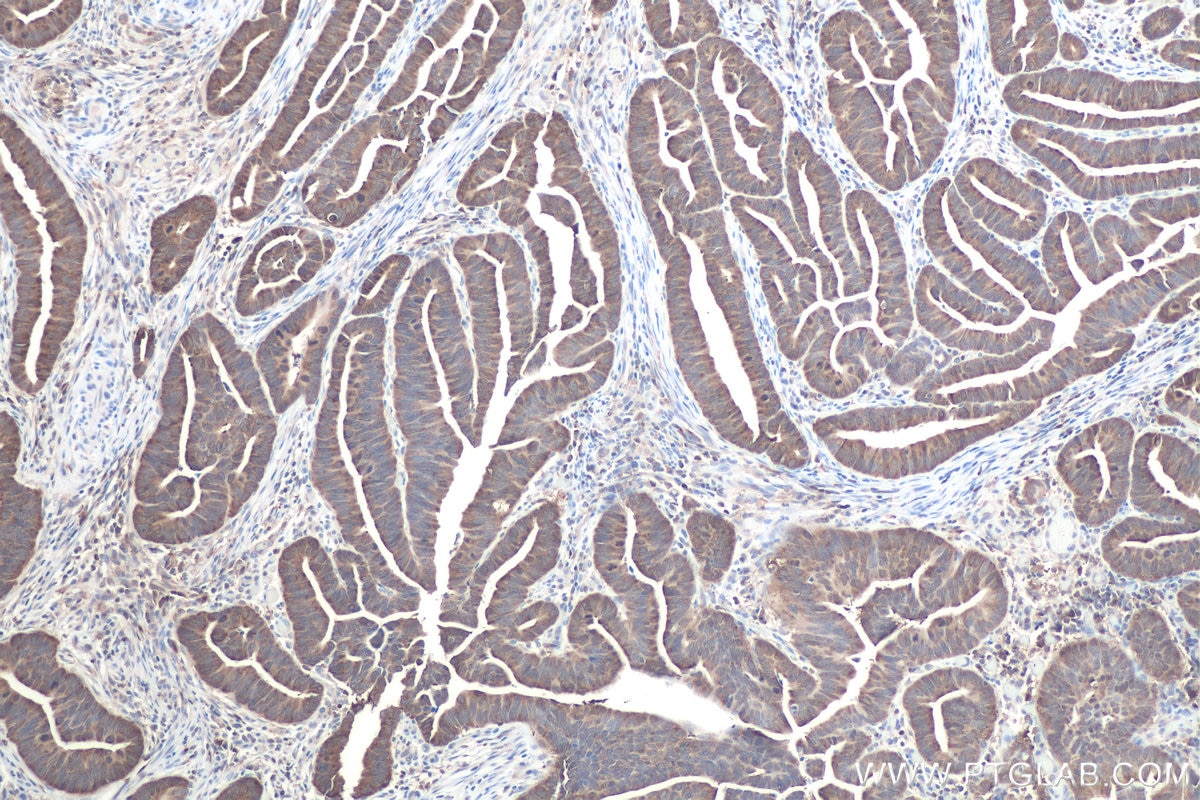 Immunohistochemistry (IHC) staining of human colon cancer tissue using CACYBP Polyclonal antibody (11745-1-AP)