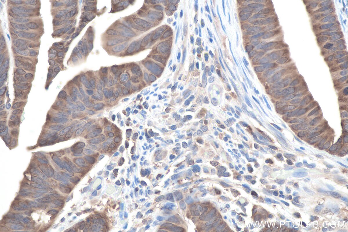 IHC staining of human colon cancer using 11745-1-AP