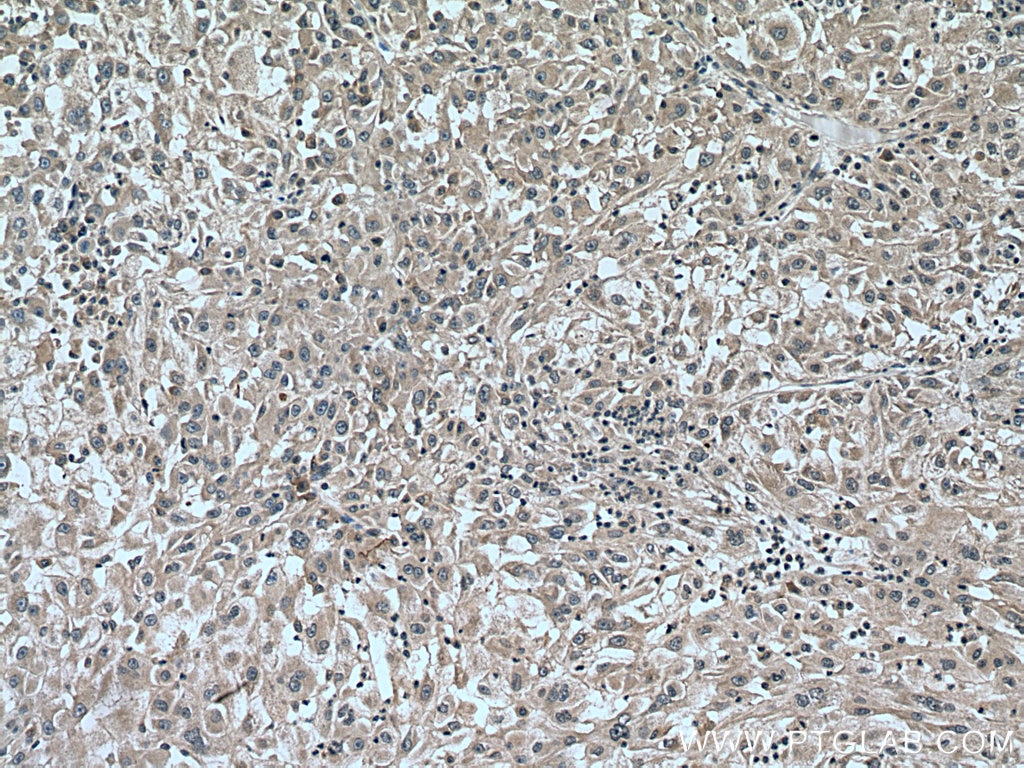 Immunohistochemistry (IHC) staining of human liver cancer tissue using CAD Polyclonal antibody (16617-1-AP)