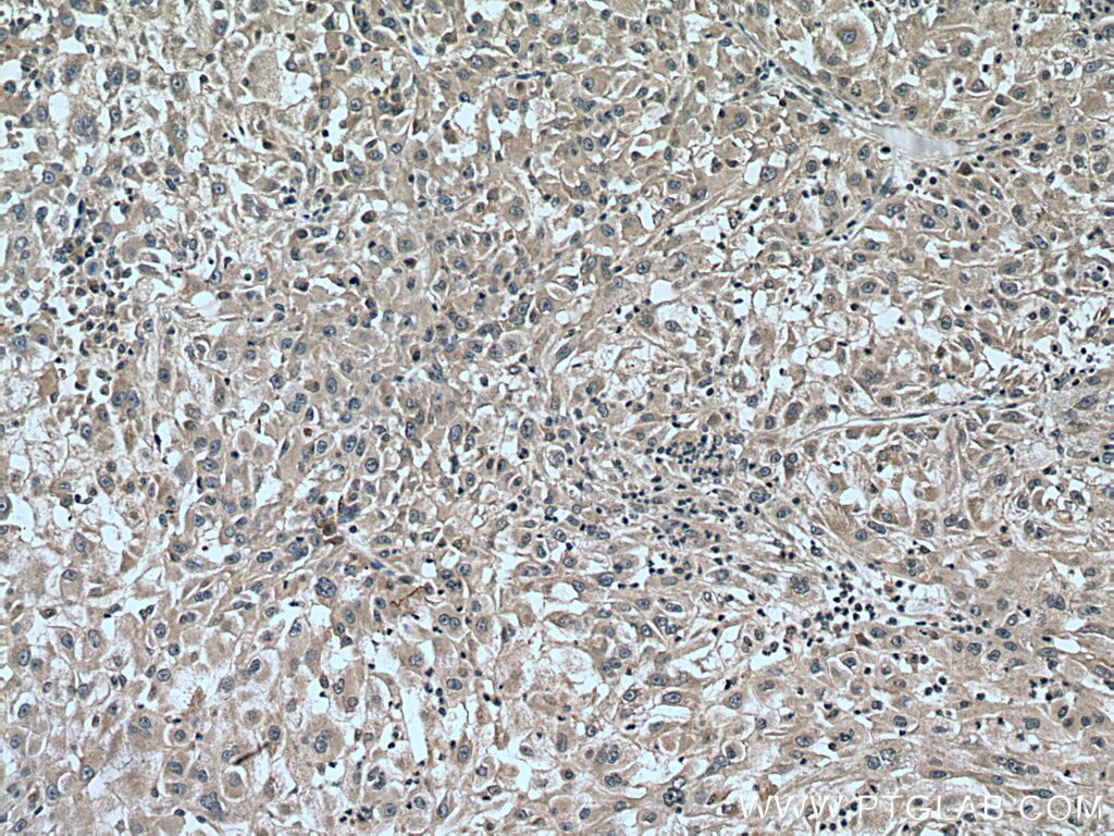 Immunohistochemistry (IHC) staining of human liver cancer tissue using CAD Polyclonal antibody (16617-1-AP)