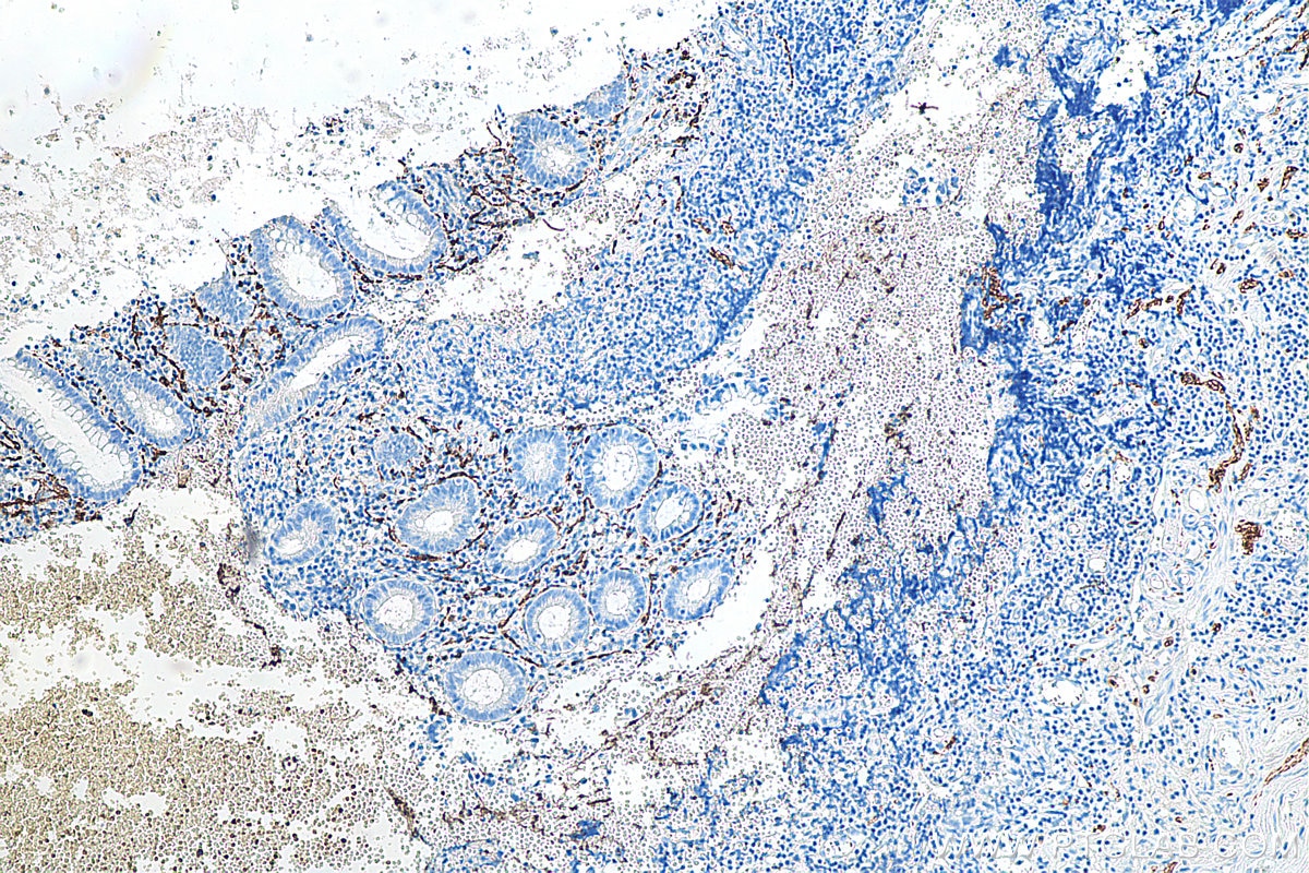 Immunohistochemistry (IHC) staining of human appendicitis tissue using Calretinin Polyclonal antibody (12278-1-AP)