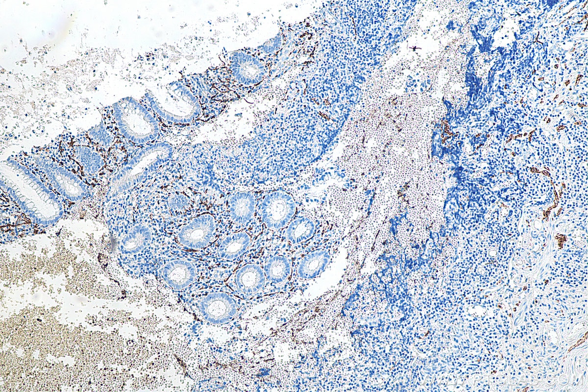 IHC staining of human appendicitis using 12278-1-AP