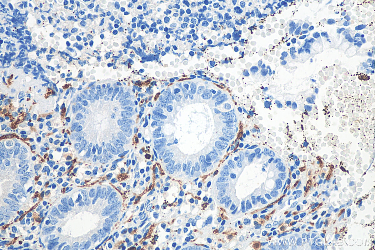 Immunohistochemistry (IHC) staining of human appendicitis tissue using Calretinin Polyclonal antibody (12278-1-AP)