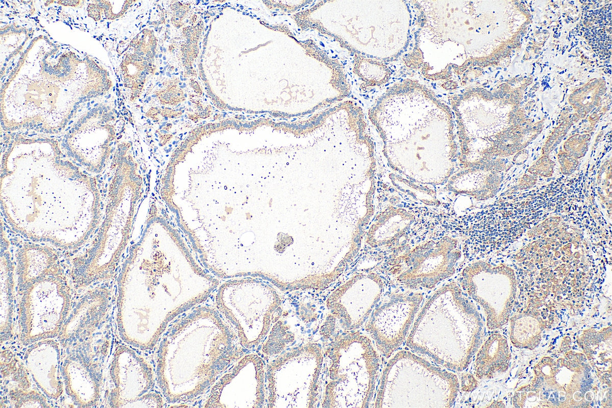 Immunohistochemistry (IHC) staining of human thyroid cancer tissue using CALCA/CGRP Monoclonal antibody (68774-1-Ig)