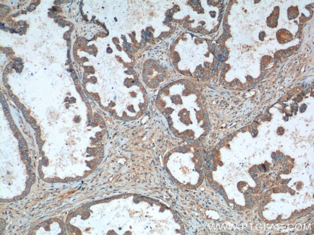 Immunohistochemistry (IHC) staining of human ovary tumor tissue using NDP52 Polyclonal antibody (12229-1-AP)