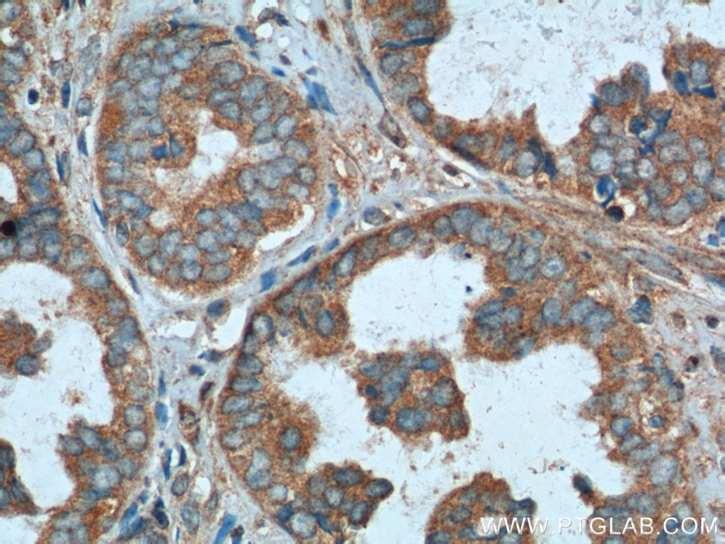 Immunohistochemistry (IHC) staining of human ovary tumor tissue using NDP52 Polyclonal antibody (12229-1-AP)
