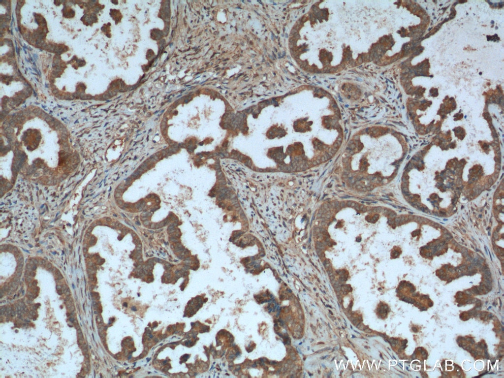 Immunohistochemistry (IHC) staining of human ovary tumor tissue using NDP52 Polyclonal antibody (12229-1-AP)