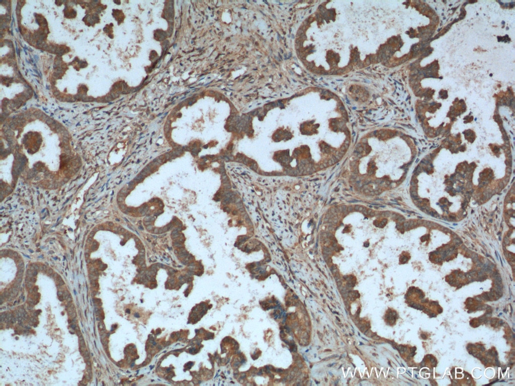 IHC staining of human ovary tumor using 12229-1-AP