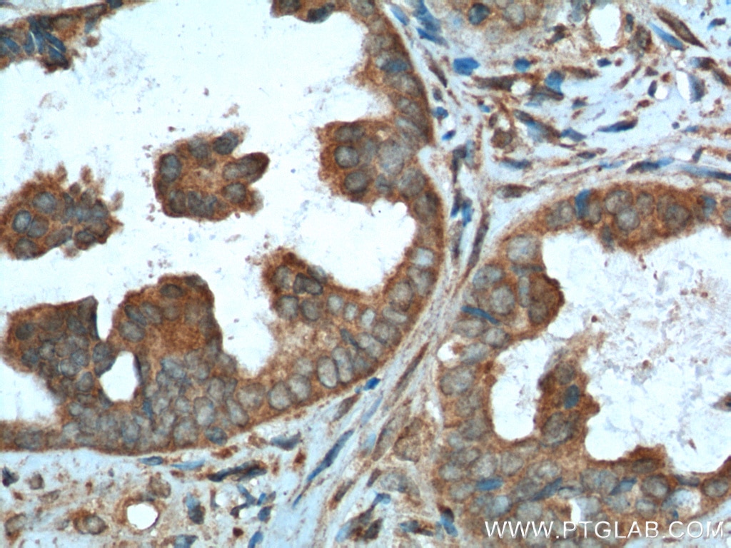 Immunohistochemistry (IHC) staining of human ovary tumor tissue using NDP52 Polyclonal antibody (12229-1-AP)