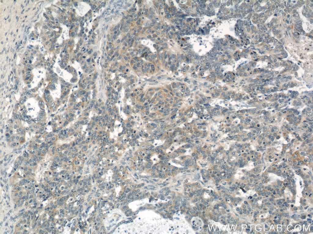 Immunohistochemistry (IHC) staining of human ovary tumor tissue using NDP52 Polyclonal antibody (12229-1-AP)