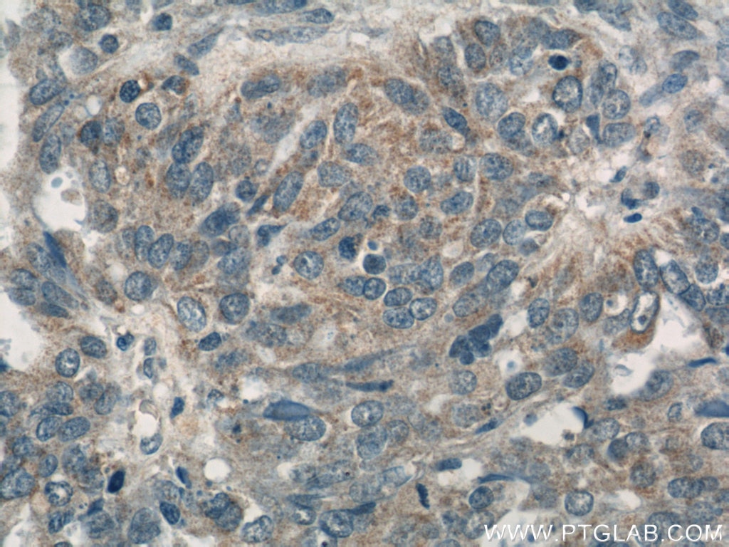 Immunohistochemistry (IHC) staining of human ovary tumor tissue using NDP52 Polyclonal antibody (12229-1-AP)