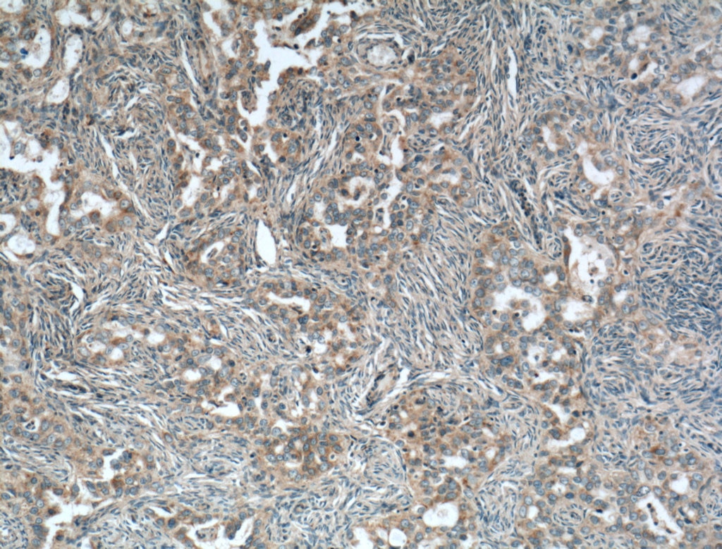 Immunohistochemistry (IHC) staining of human ovary tumor tissue using NDP52 Monoclonal antibody (66401-1-Ig)