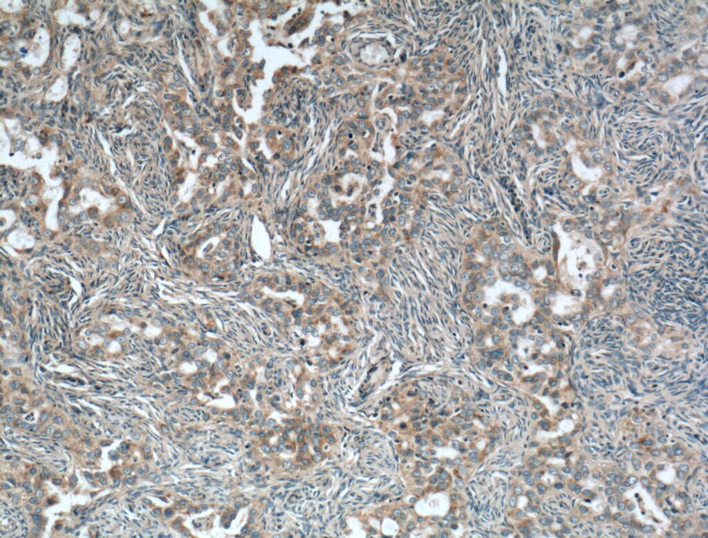 IHC staining of human ovary tumor using 66401-1-Ig