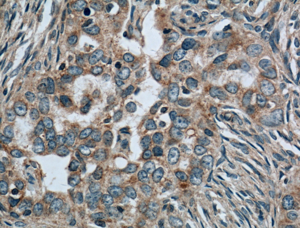 Immunohistochemistry (IHC) staining of human ovary tumor tissue using NDP52 Monoclonal antibody (66401-1-Ig)