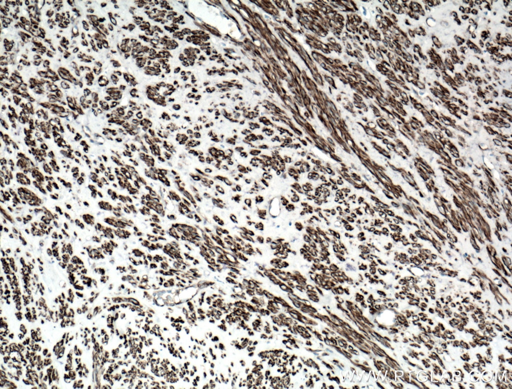 Immunohistochemistry (IHC) staining of human hysteromyoma tissue using CALD1 Monoclonal antibody (66693-1-Ig)