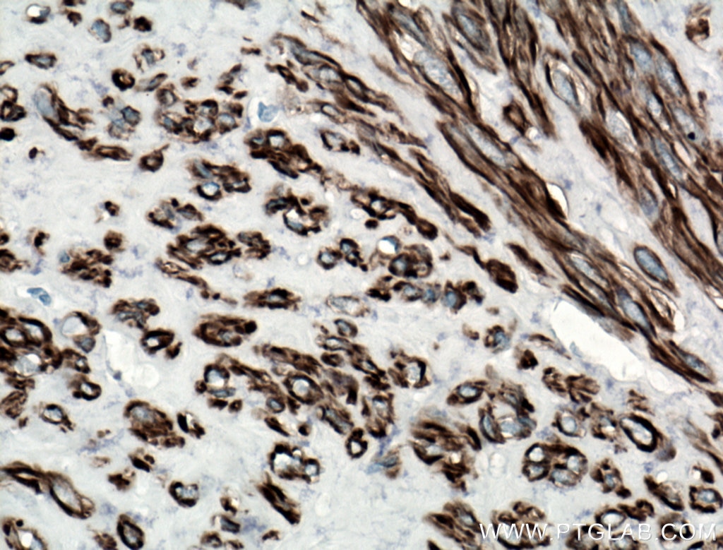 Immunohistochemistry (IHC) staining of human hysteromyoma tissue using CALD1 Monoclonal antibody (66693-1-Ig)