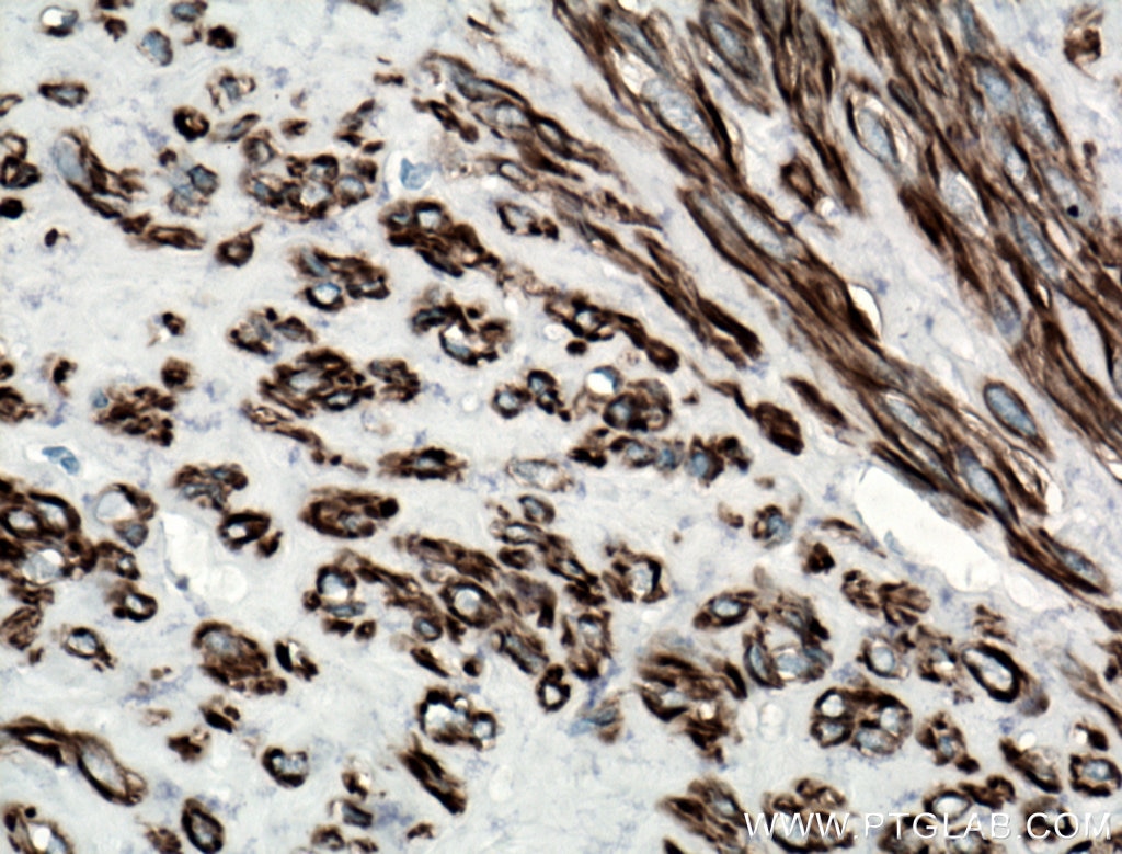 IHC staining of human hysteromyoma using 66693-1-Ig