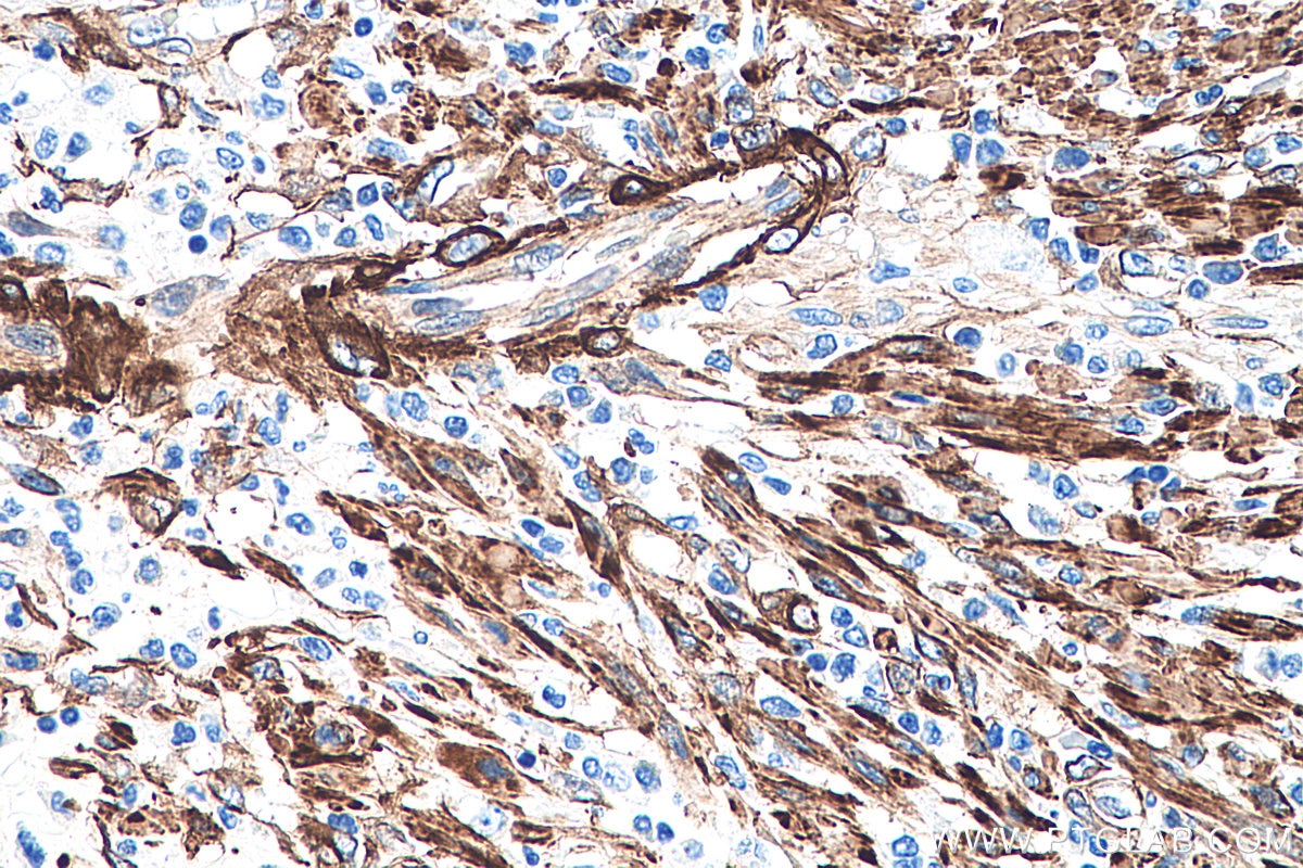 Immunohistochemistry (IHC) staining of human colon cancer tissue using CALD1 Monoclonal antibody (66693-1-Ig)