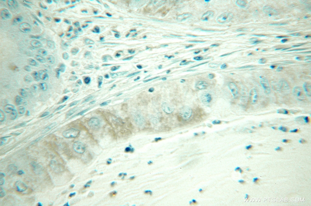 Immunohistochemistry (IHC) staining of human lung cancer tissue using Calmodulin 1/2/3 Polyclonal antibody (10303-1-AP)