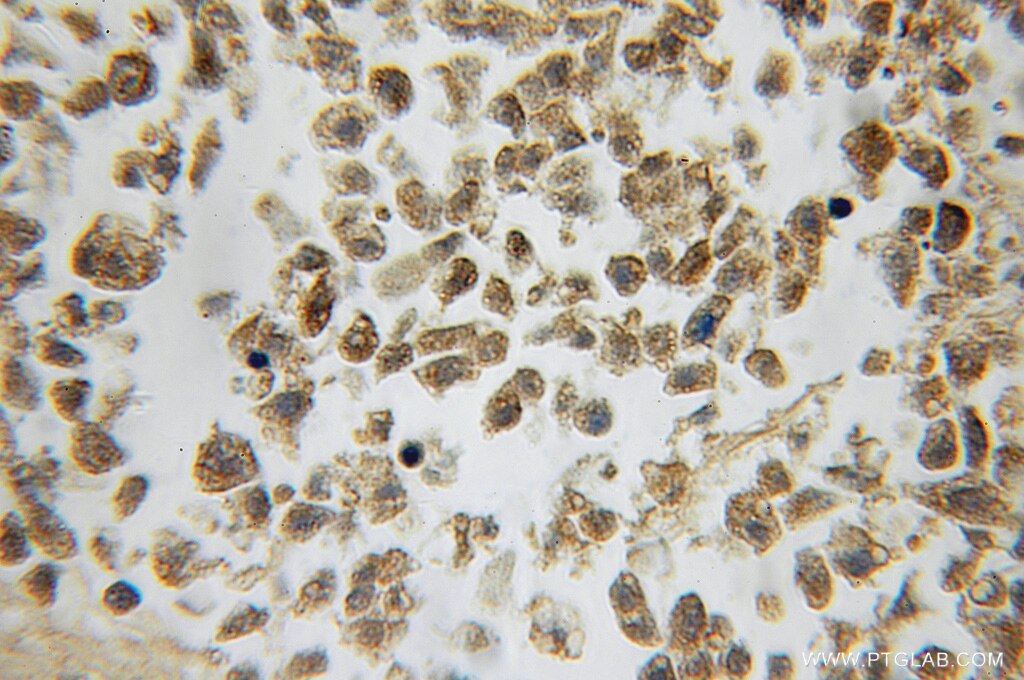 IHC staining of human lung cancer using 10112-1-AP
