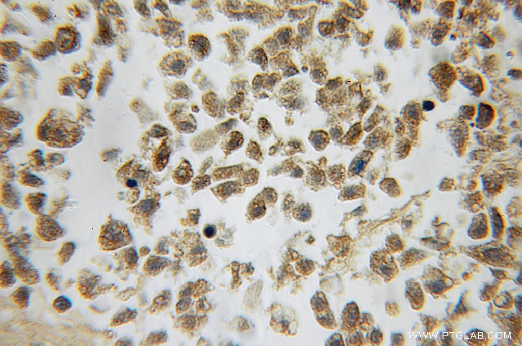 Immunohistochemistry (IHC) staining of human lung cancer tissue using Calmodulin1/2/3 Polyclonal antibody (10112-1-AP)