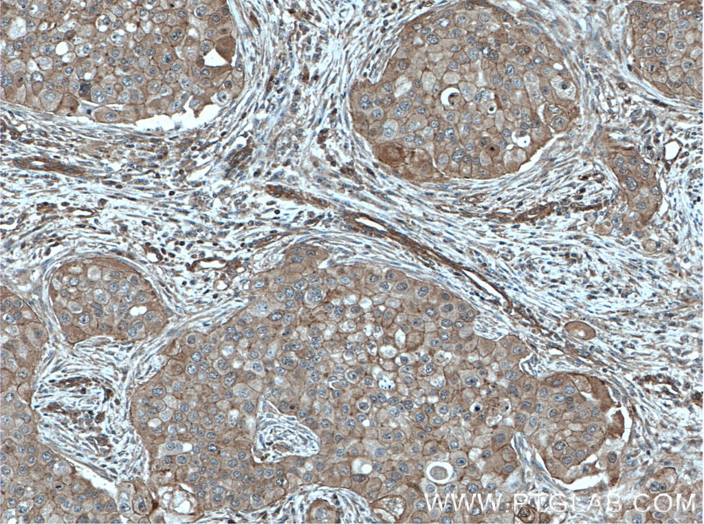 Immunohistochemistry (IHC) staining of human breast cancer tissue using Calmodulin Polyclonal antibody (10541-1-AP)