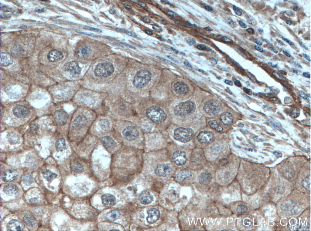 Immunohistochemistry (IHC) staining of human breast cancer tissue using Calmodulin Polyclonal antibody (10541-1-AP)