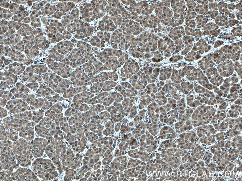Immunohistochemistry (IHC) staining of human liver cancer tissue using CALML3 Polyclonal antibody (17275-1-AP)