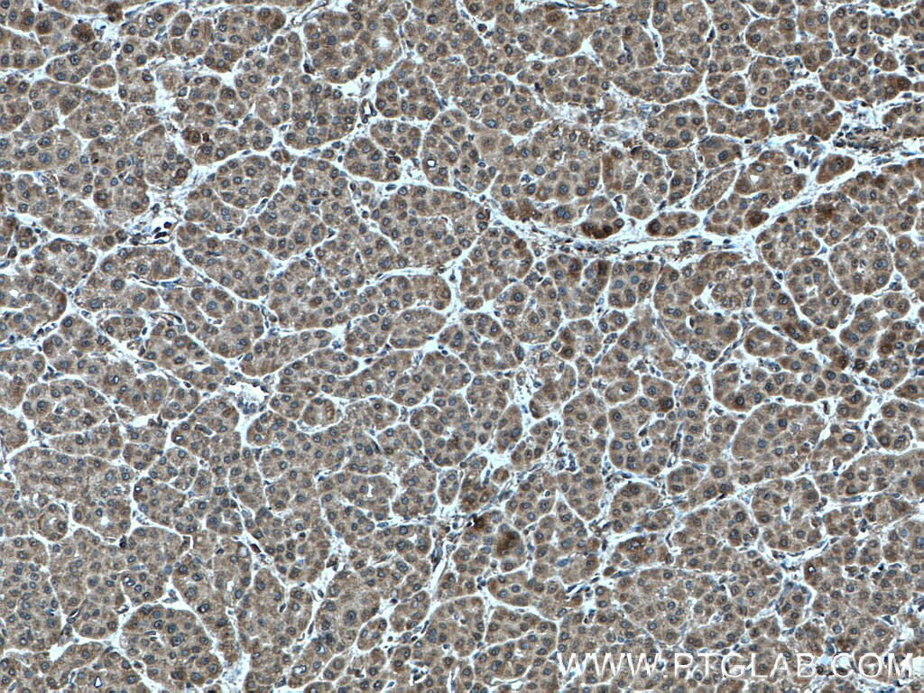 IHC staining of human liver cancer using 17275-1-AP