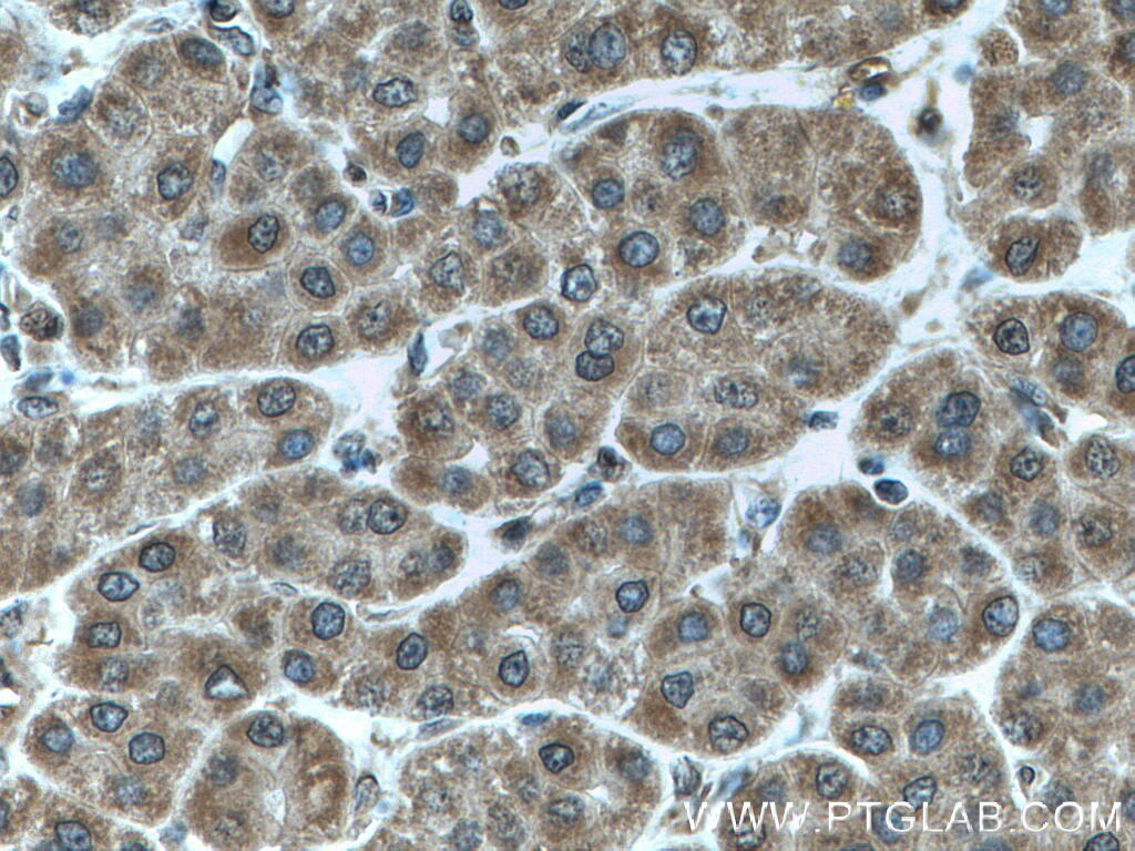 Immunohistochemistry (IHC) staining of human liver cancer tissue using CALML3 Polyclonal antibody (17275-1-AP)