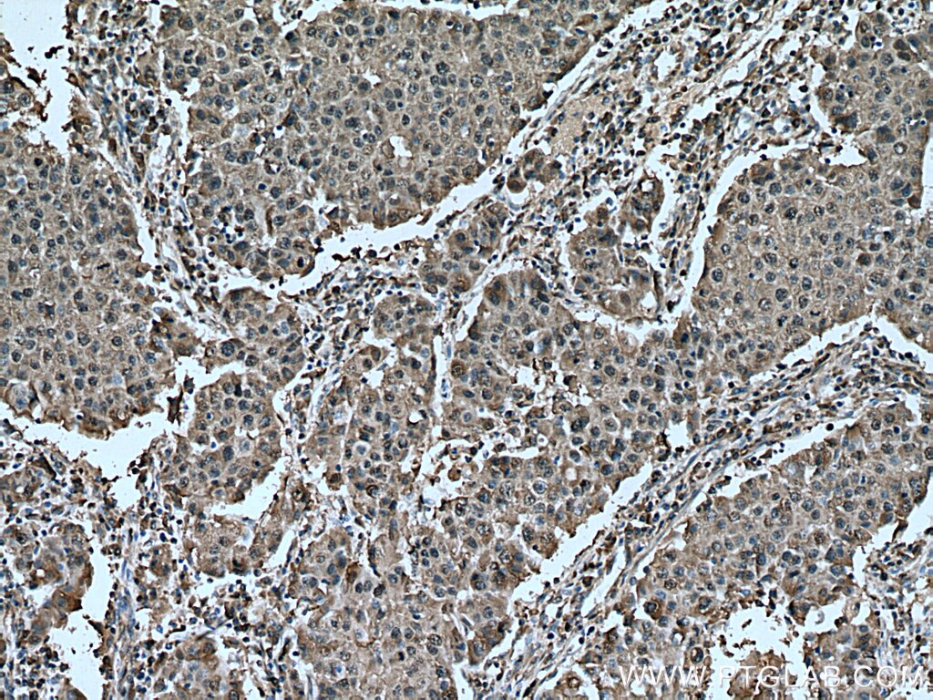 Immunohistochemistry (IHC) staining of human breast cancer tissue using CALML5 Polyclonal antibody (13059-1-AP)