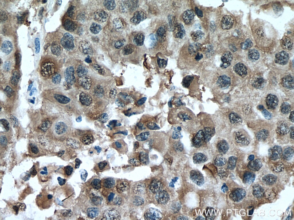 Immunohistochemistry (IHC) staining of human breast cancer tissue using CALML5 Polyclonal antibody (13059-1-AP)