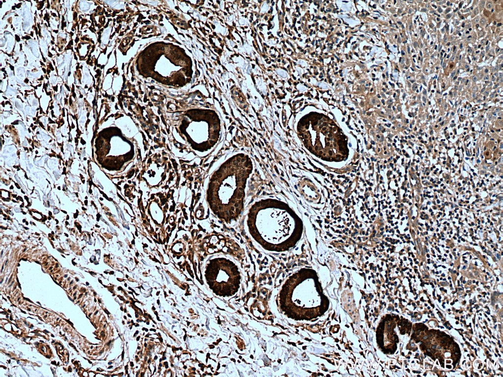 Immunohistochemistry (IHC) staining of human skin cancer tissue using CALML5 Polyclonal antibody (13059-1-AP)