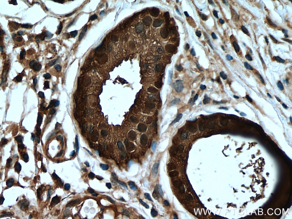 Immunohistochemistry (IHC) staining of human skin cancer tissue using CALML5 Polyclonal antibody (13059-1-AP)