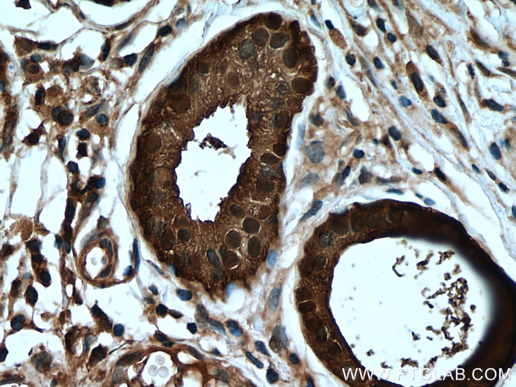 IHC staining of human skin cancer using 13059-1-AP