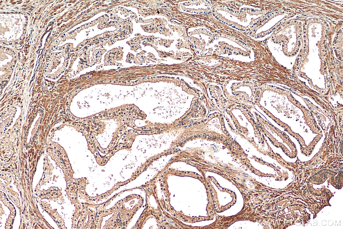 Immunohistochemistry (IHC) staining of human prostate hyperplasia tissue using CALML6 Polyclonal antibody (22274-1-AP)