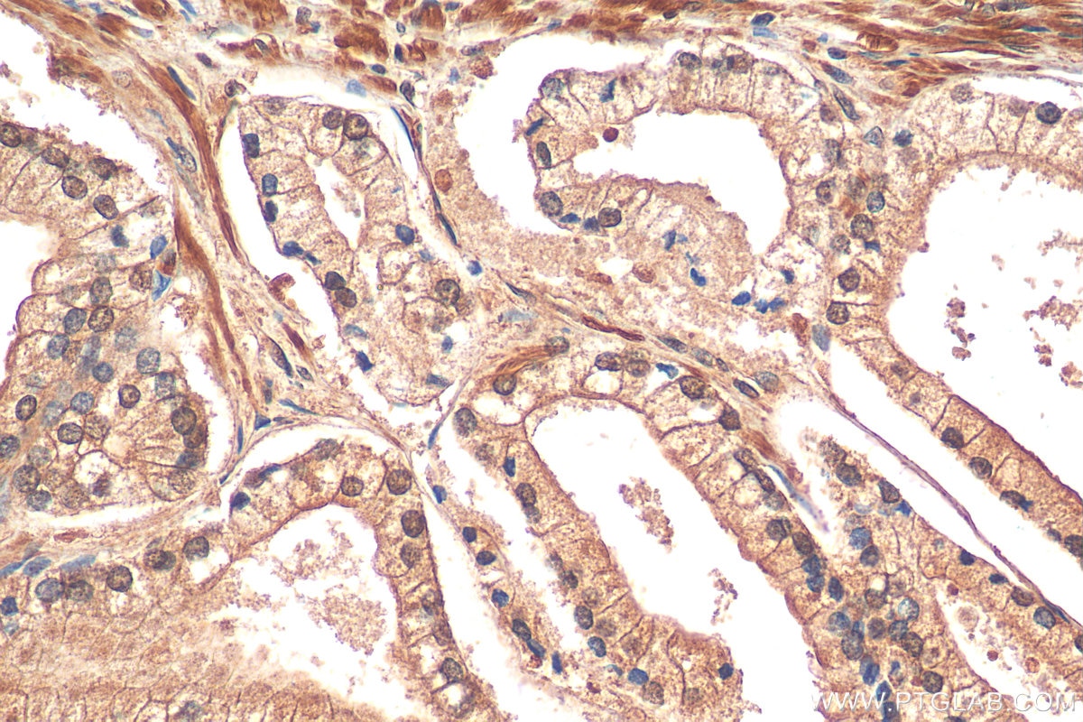 Immunohistochemistry (IHC) staining of human prostate hyperplasia tissue using CALML6 Polyclonal antibody (22274-1-AP)