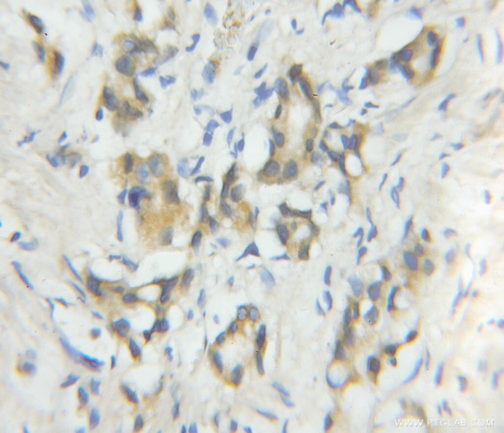 Immunohistochemistry (IHC) staining of human prostate cancer tissue using CALN1 Polyclonal antibody (11477-1-AP)