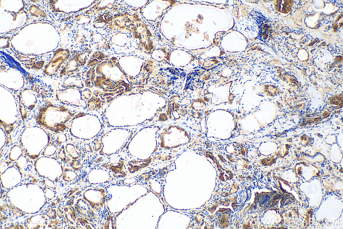 Immunohistochemistry (IHC) staining of human thyroid cancer tissue using calreticulin Polyclonal antibody (10292-1-AP)