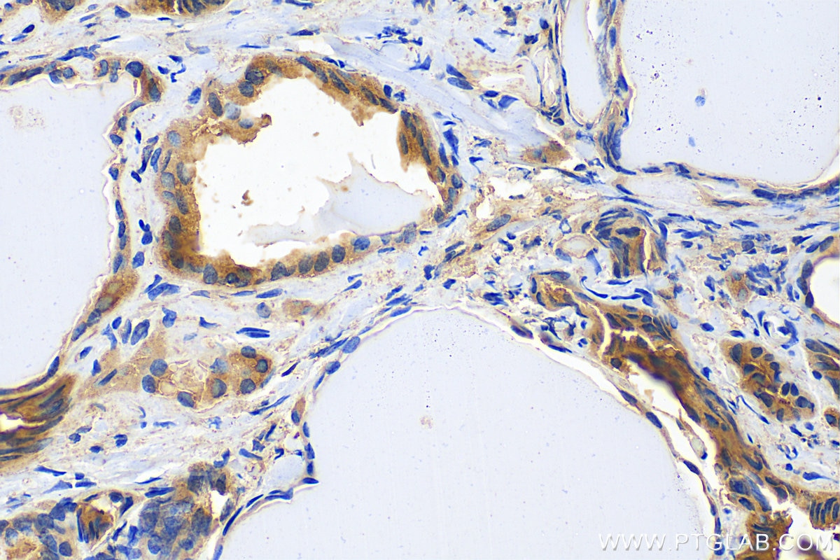 Immunohistochemistry (IHC) staining of human thyroid cancer tissue using calreticulin Polyclonal antibody (10292-1-AP)