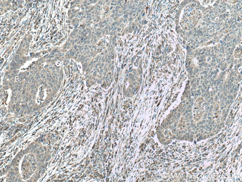 Immunohistochemistry (IHC) staining of human colon cancer tissue using CAMK1 Polyclonal antibody (24312-1-AP)