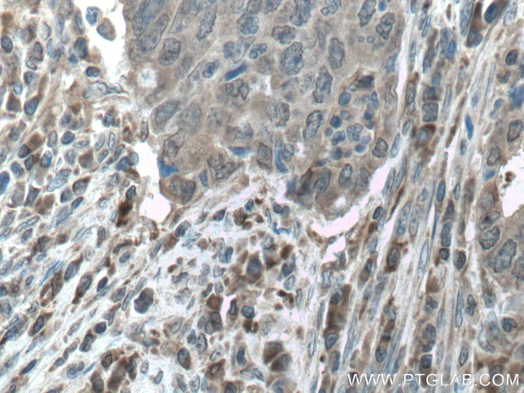 Immunohistochemistry (IHC) staining of human colon cancer tissue using CAMK1 Polyclonal antibody (24312-1-AP)