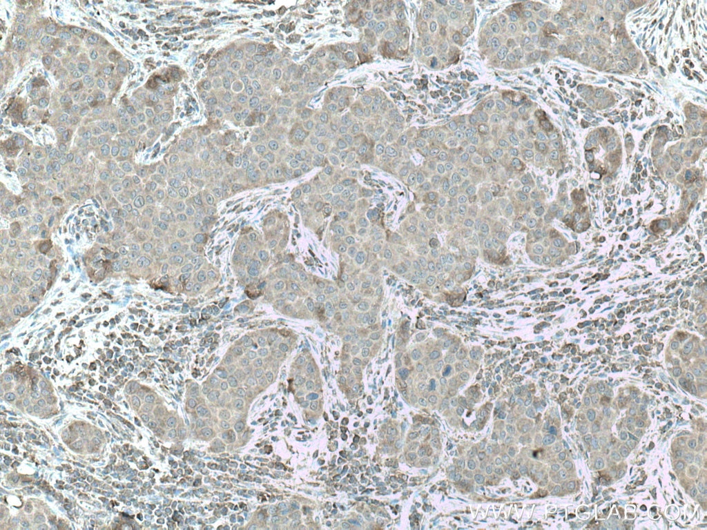 Immunohistochemistry (IHC) staining of human breast cancer tissue using CAMK1 Polyclonal antibody (24312-1-AP)